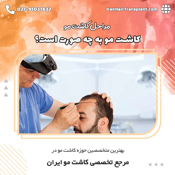 مراحل کاشت مو به چه صورت است؟