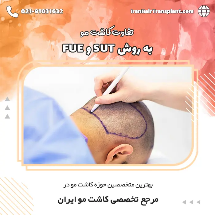 تفاوت کاشت مو به روش SUT با کاشت مو به روش FUE چیست؟