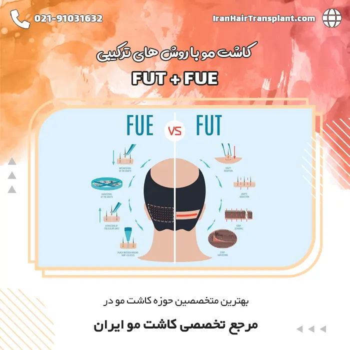 کاشت مو به روش ترکیبی FIT و FUT