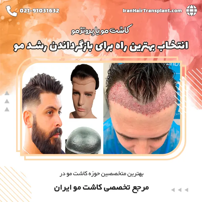 کاشت مو بهتره یا پروتز مو؟