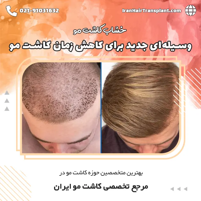 میکرو ایمپلنت، ابزار جدیدی برای کاهش مدت زمان کاشت مو