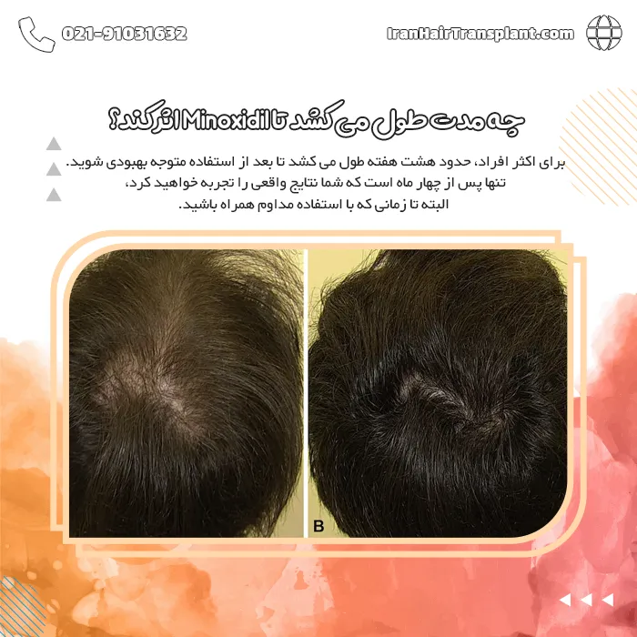 چه مدت طول می کشد تا Minoxidil اثر کند؟